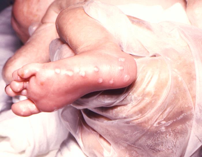 This image depicts the right foot of an infant born with a herpes simplex infection, known as neonatal herpes, or herpes simplex neonatorum, which had manifested itself through the development of maculopapular lesions of the foot’s heal and sole. See PHIL 6510, for another view of this condition.Adapted from CDC