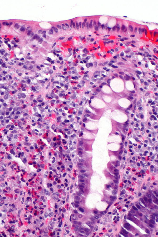 Allergic colitis. H and E stain shows abundant eosinophils ref name=allergiccolitis1> Libre Pathology. https://librepathology.org/wiki/Eosinophilic_colitis Accessed on September 17, 2016 </ref>
