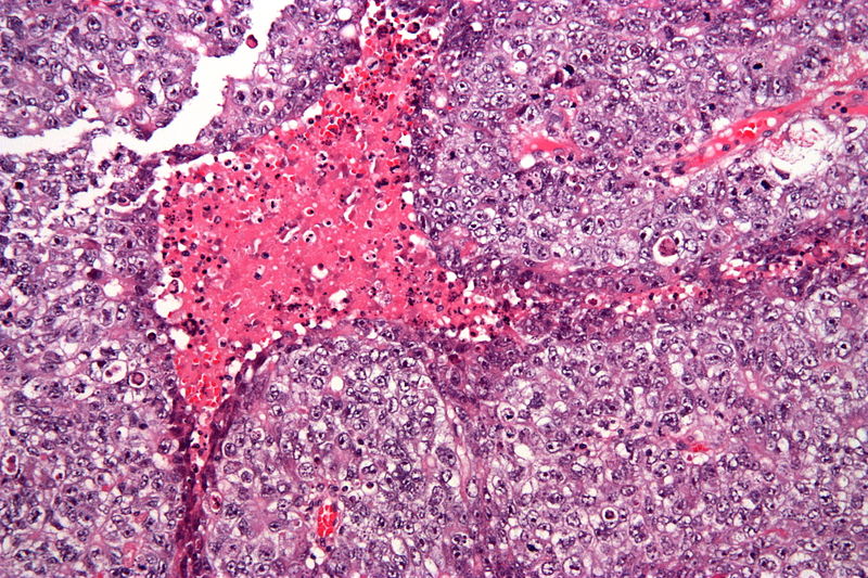 File:800px-Embryonal carcinoma - high mag.jpg