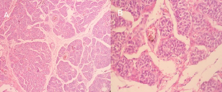 testicular parenchyma of lobulated architecture, made of seminiferous tubes of atrophic appearance; B) these tubes are lined with Sertolia cells, with no obvious signs of spermatogenesis the interstitium is fibrous with rare clusters of Leydig cells.[2]