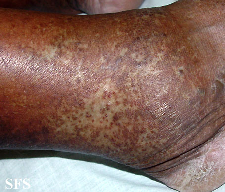 Atrophie Blanche. Adapted from Dermatology Atlas.<ref name="Dermatology Atlas">{{Cite