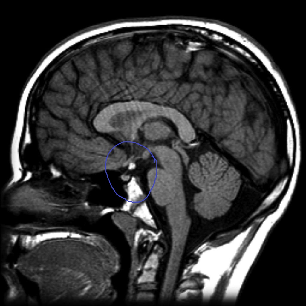 File:Ectopic-posterior-pituitary-1.jpg