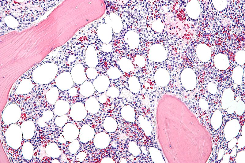 File:Hairy cell leukemia - high mag.jpg
