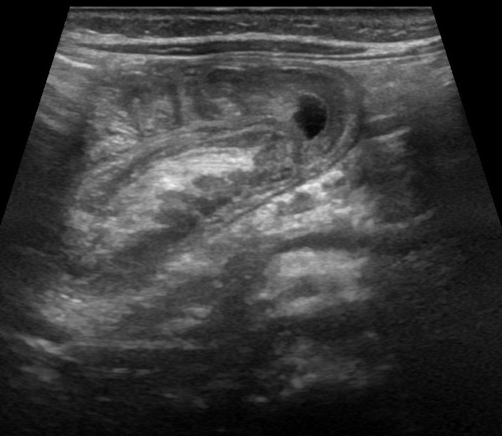 File:Intussusception-with-pseudokidney-and-target-sign-1.jpg