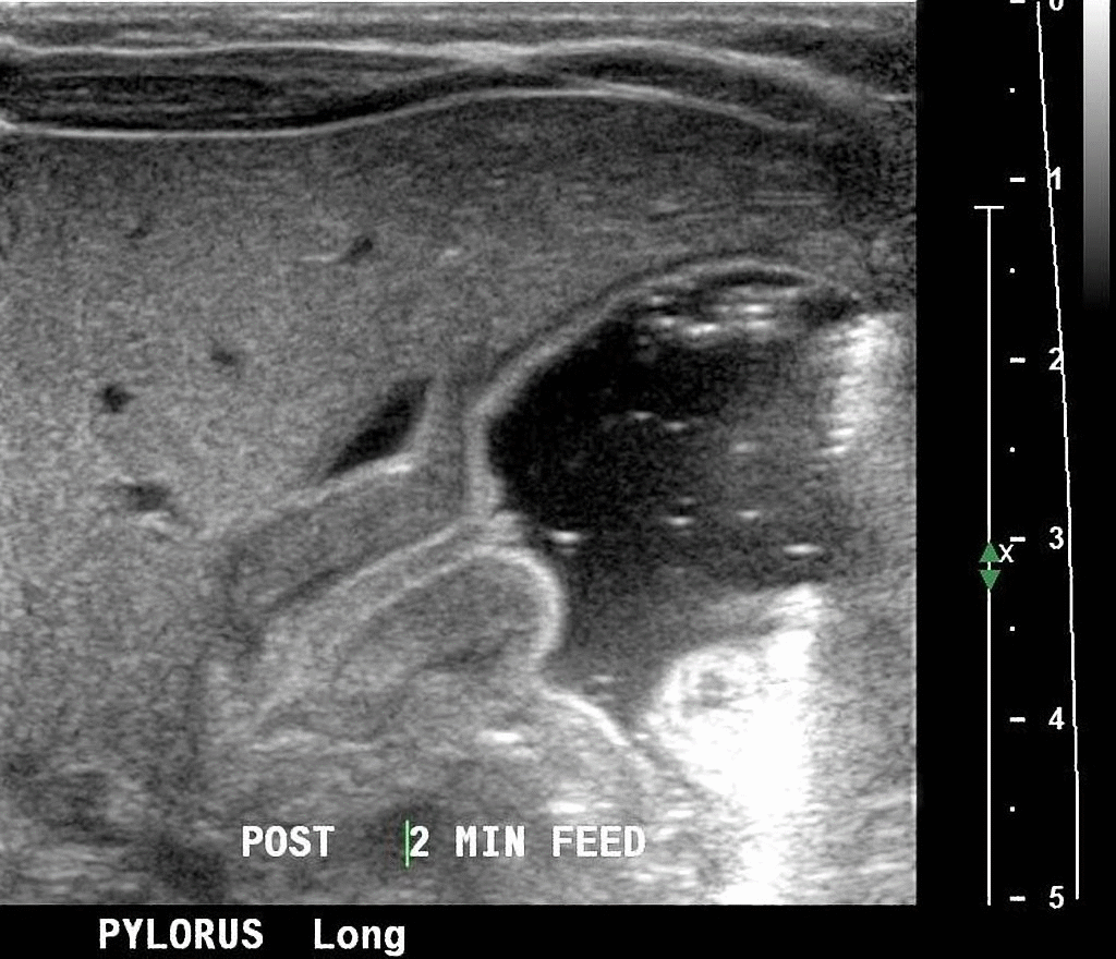 File:Pyloric stenosis nipple sign GIF.gif