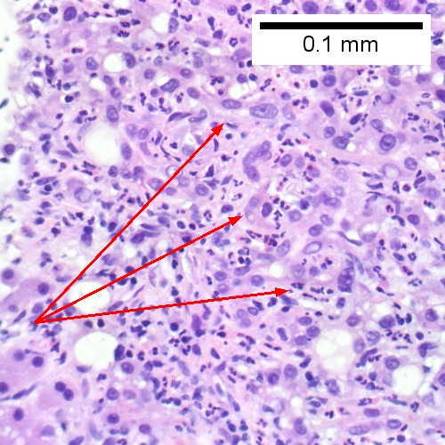 C, Proliferated bile ductules (arrows) bearing neutrophils within epithelium and lumens are features of obstruction that should prompt a search for interlobular ducts with acute inflammation