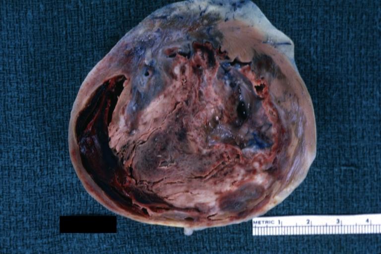 Left Ventricular Aneurysm; Gross pathology: The horizontal section shows the apex of the left ventricle with aneurysmal dilation and mural thrombus. A large scar tissue can be seen in the myocardium.