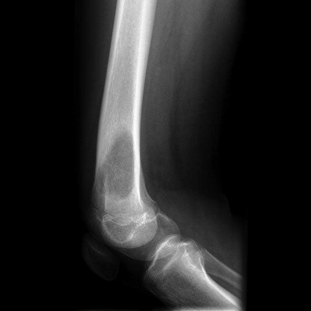 Osteosarcoma of distal femur lateral view[2] . http://radiopaedia.org/articles/osteosarcoma