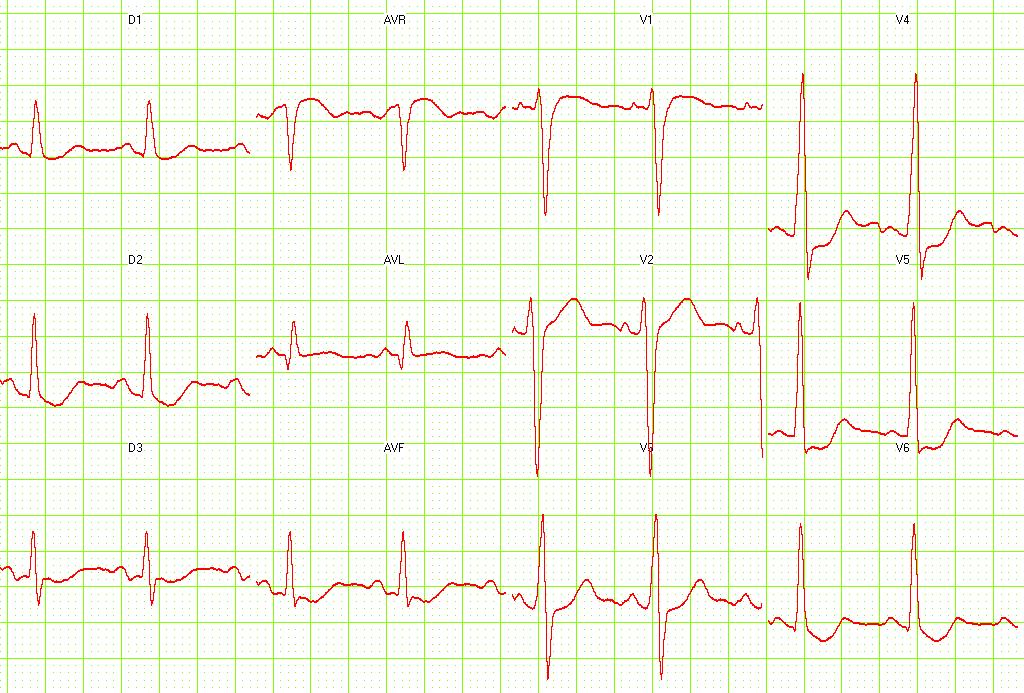 Digital effect on EKG. Courtesy of Dr Jose Ganseman