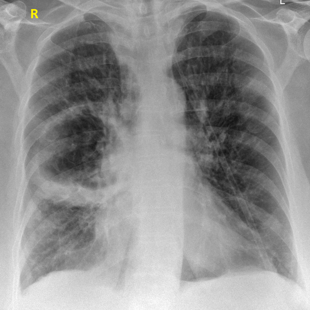 File:Lung abscess chest X ray.gif
