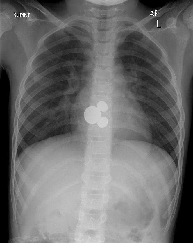 A 7 year old girl presented to ED after swallowing a foreign body. Initial CXR shows a foreign body at the level of T8. There was no change in the position of the Mickey Mouse key ring after 8 hours. No pneumomediastinum or pneumothorax. The airway is patent. It was finally retrieved with oesophagoscopy. (Image courtesy of Dr Lily Wang)