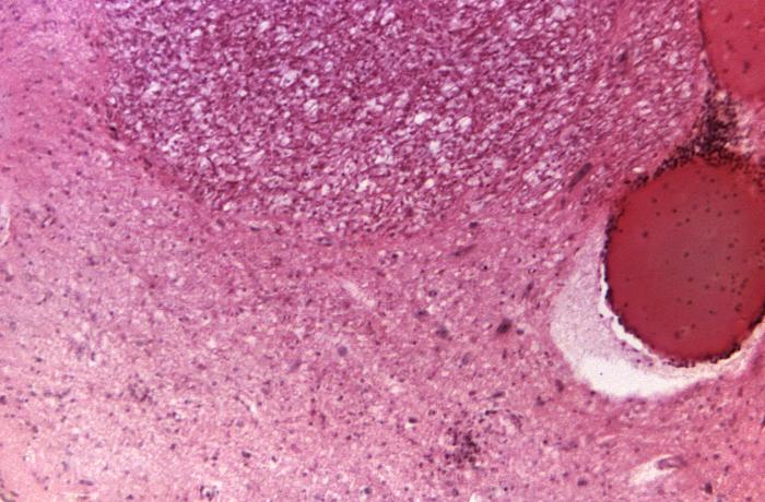 Under a low magnification, this photomicrograph of pontine tissue at the level of abducens nucleus reveals histopathologic changes in a poliomyelitis patient.Adapted from Public Health Image Library (PHIL), Centers for Disease Control and Prevention.[17]