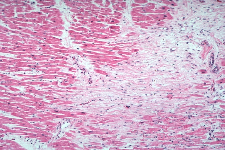 Lupus Erythematosus Focal Myocardial Scar Due To Libman Sacks Embolism: Micro low mag H&E focal scar in myocardium due to embolism