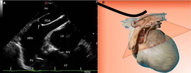 File:Transesophageal echocardiogram of a patent ductus arteriosus.jpg