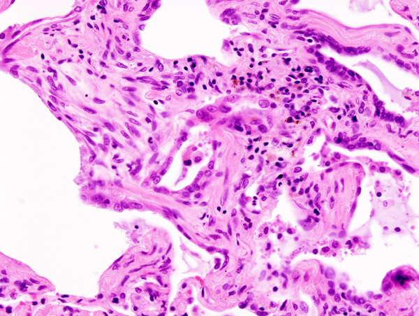 Histopathological image of pulmonary fibrosis representing chronic interstitial pneumonitis.