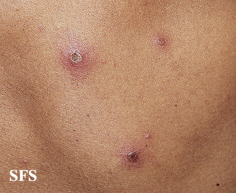 Vasculitis leukocytoclasia. From Public Health Image Library (PHIL). [1]