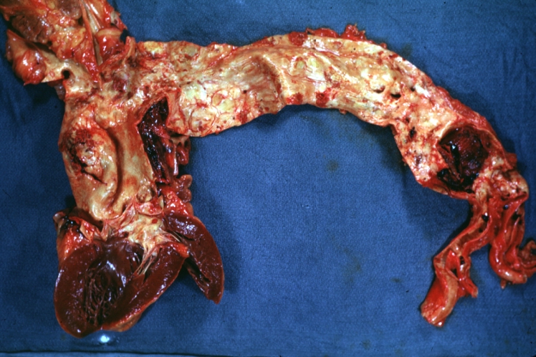 Atherosclerosis: Dissecting Aortic Aneurysm: Gross, shows dilated aorta with extensive atherosclerosis dissection is seen. A small abdominal aorta, atherosclerotic aneurysm is present. A good picture for association of dilation with dissection