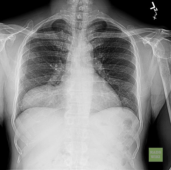 Chest X-ray showing Pericardial cyst Image courtesy of RadsWiki and copylefted
