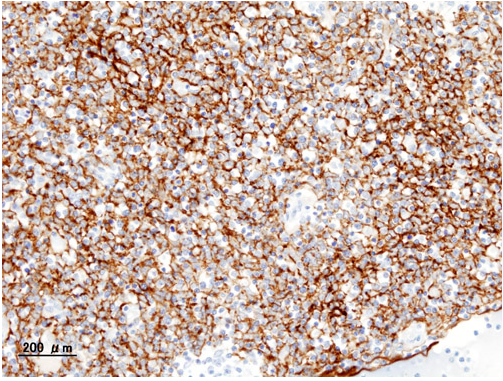 Histopathological image of Thymoma type B1. Anterior mediastinal mass surgically resected. Cytokeratin CAM5.2 immunostain