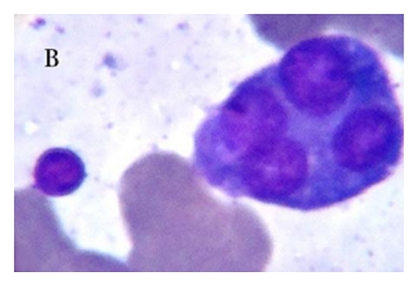Tetranucleated plasmacytoid/plasma cell and lymphoid cell in the bone marrow aspirates