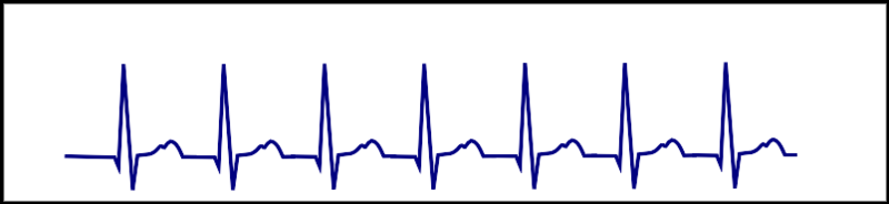 AVRT - inverted p wave behind every QRS complex