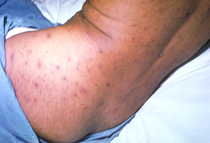Chickenpox lesions on the skin of this patient's back and buttocks at day 6 of the illness. From Public Health Image Library (PHIL). [3]