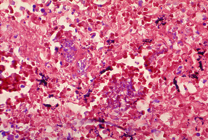 "Histopathology of mediastinal lymph node in fatal human anthrax” Adapted from Public Health Image Library (PHIL), Centers for Disease Control and Prevention.[20]