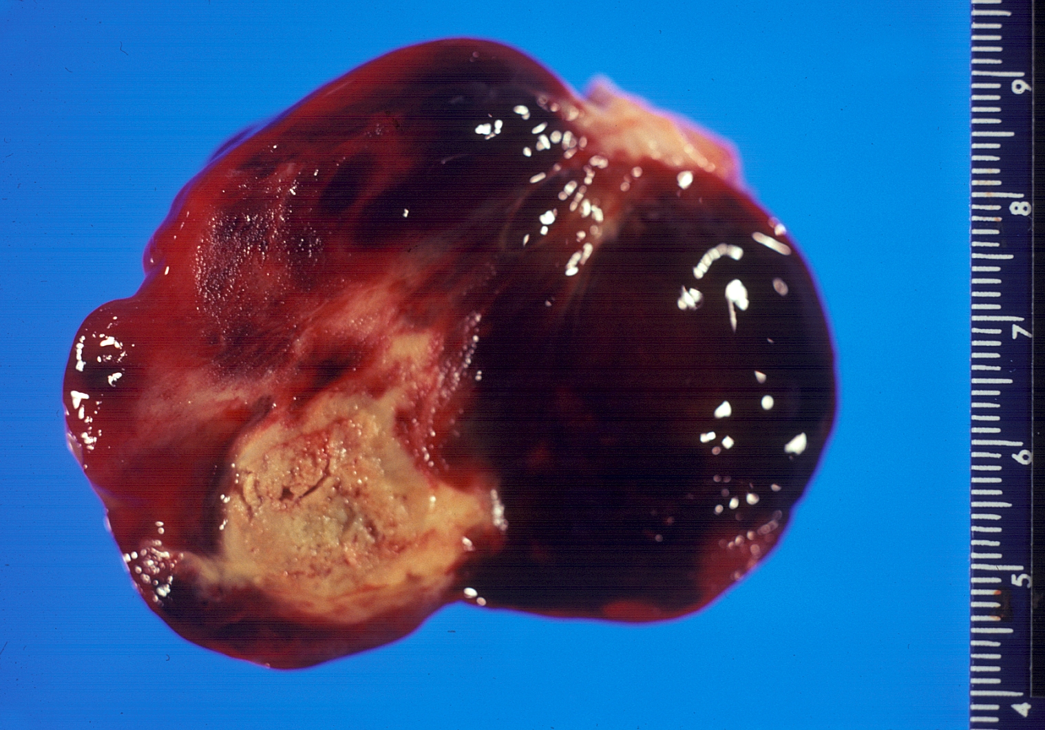 Gross pathology atrial myxoma: myxomas are brownish or white and are frequently covered with thrombus