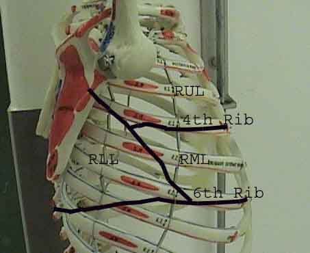 Lung thorax rlat line.jpg