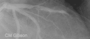 Plaque rupture and coronary thrombosis in the left anterior descending artery with distal embolization.gif