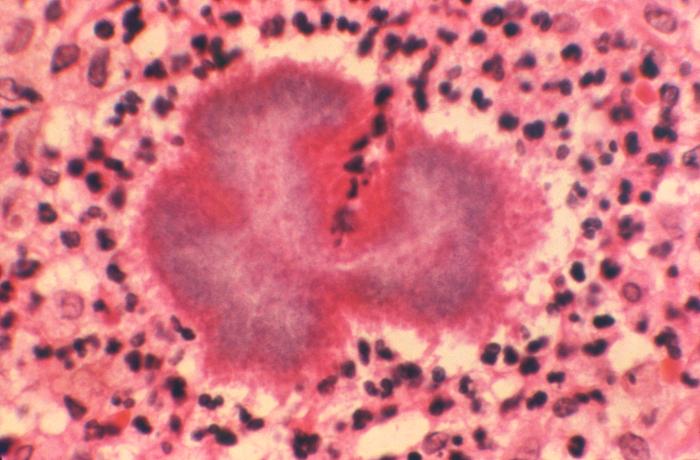Hematoxylin-eosin (H&E) stained photomicrograph of a tissue sample of a mycetoma excised from a patient’s thorax ill with nocardiosis, revealed the presence of a tissue granule due to the bacterium, Nocardia brasiliensis. From Public Health Image Library (PHIL). [1]