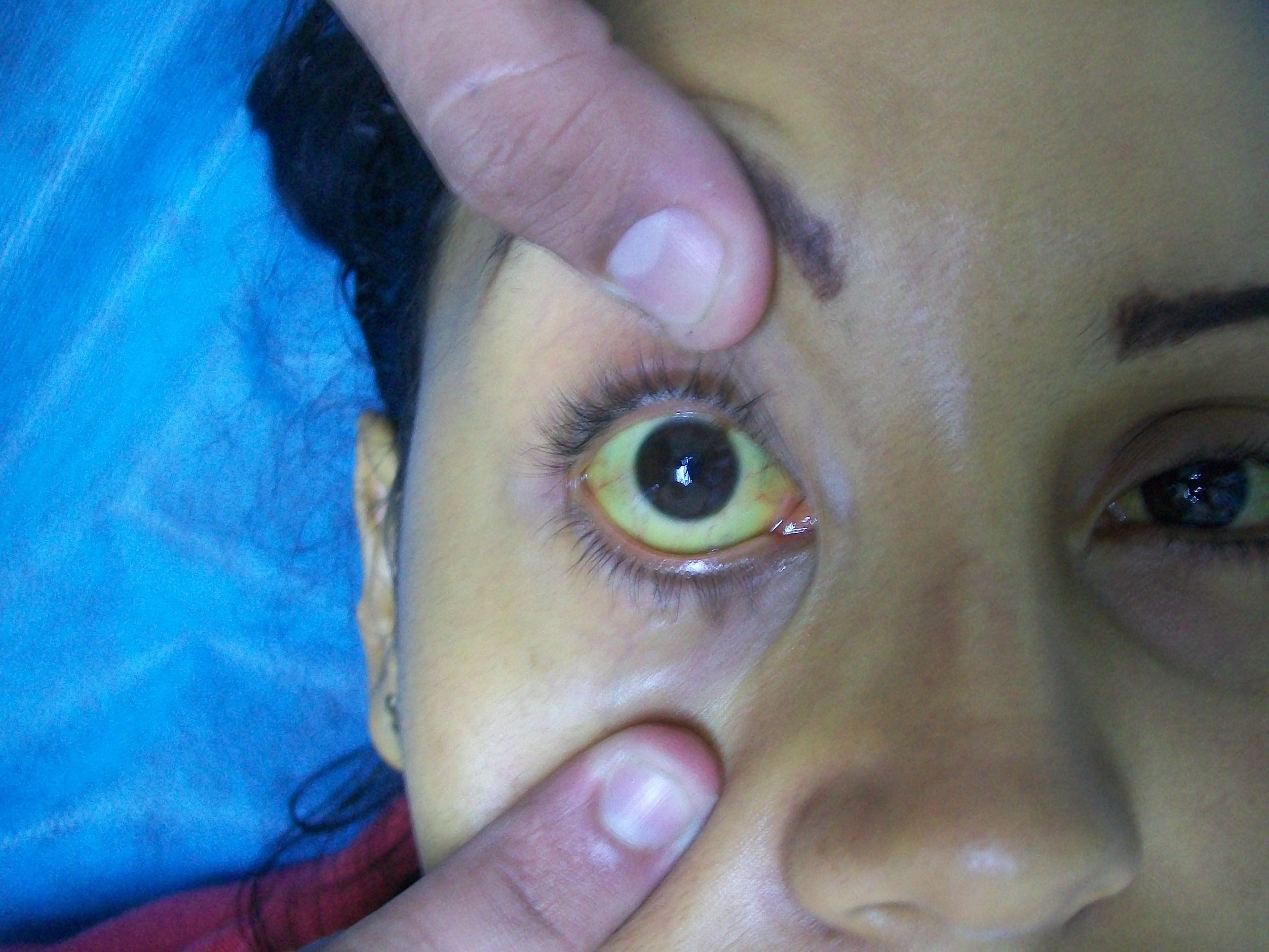 Sclerotic jaundice in a female patient with ascending cholangitis, Maracay, Venezuela.[1]