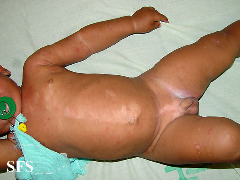 Incontinentia pigmenti achromians of Ito. Adapted from Dermatology Atlas.[2]