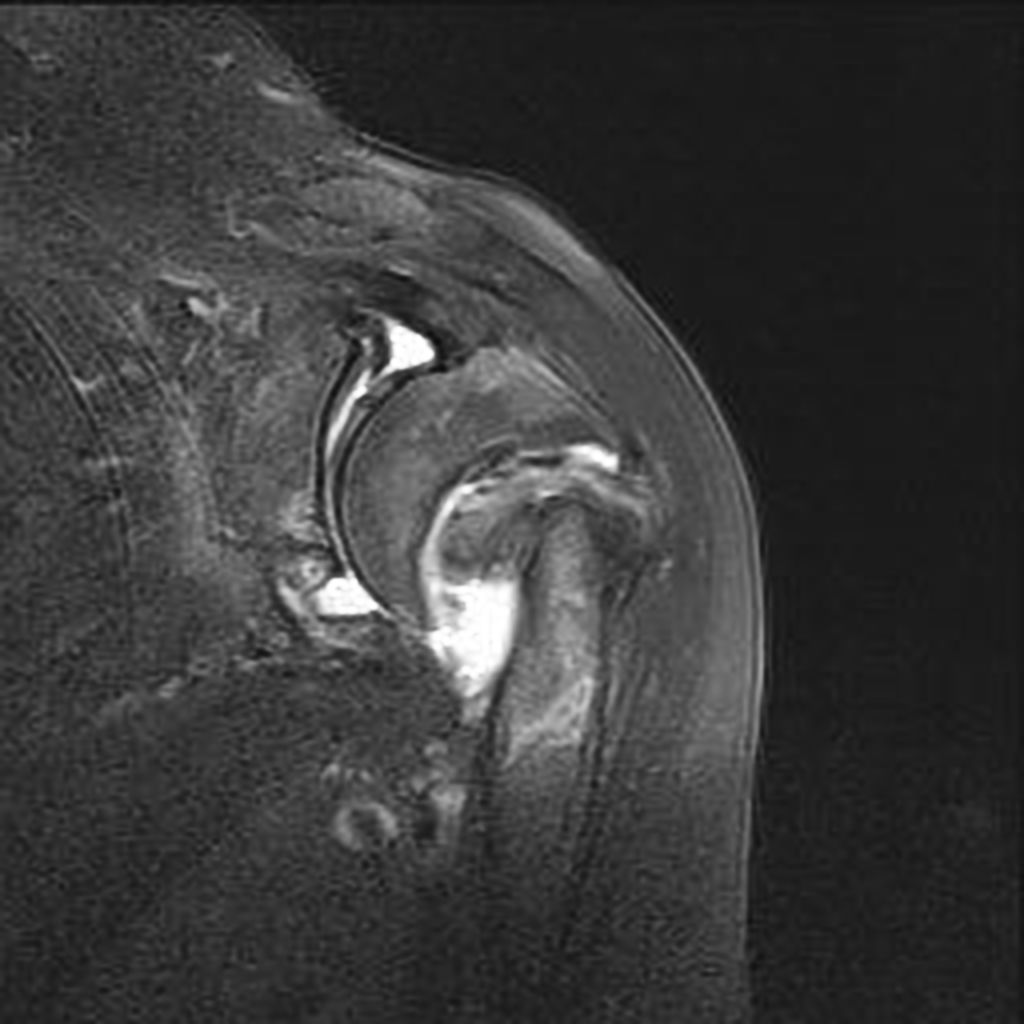 Coronal STIR- Complete fracture of the anatomical neck of the humeral head with displaced bone fragments, and rotation and bone resorption. Presence of fluid between the bone fragments, with joint effusion and significant synovial thickening (synovitis).