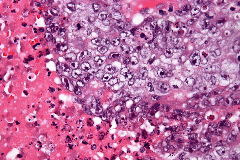 File:800px-Embryonal carcinoma - very high mag - cropped.jpg
