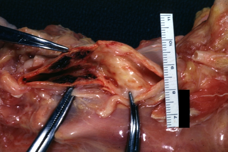 Carotid artery: Atherosclerosis: Gross, good example of carotid bulb plaque with thrombus