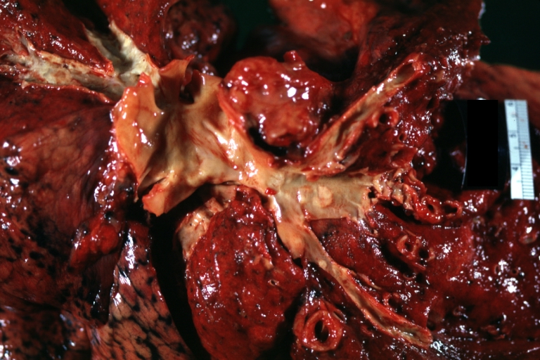 Lung: Atherosclerosis: Gross, natural color, arteries show atherosclerotic plaque lesions