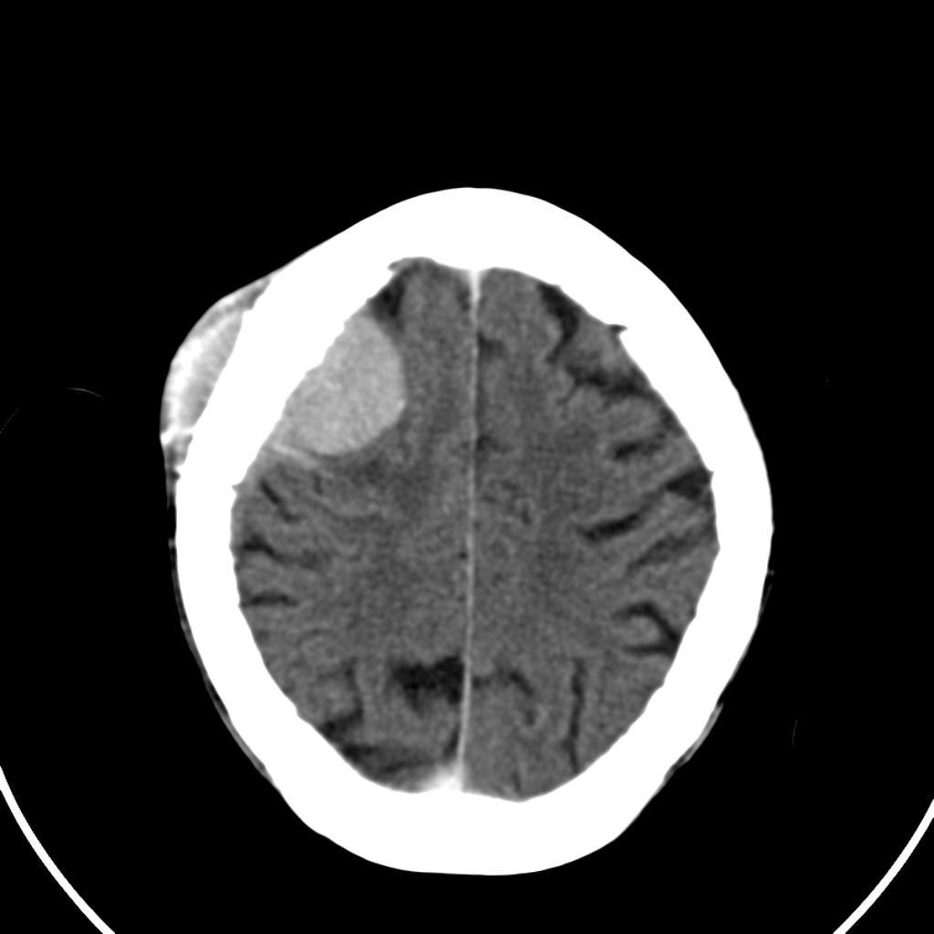 File:Atypical-meningioma-5.jpg