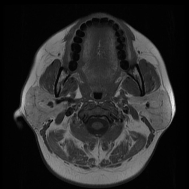 Axial T1 MRI of squamous cell carcinoma of tongue[2]