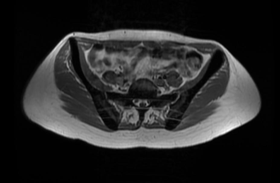 File:Osteopetrosis MRI 203.jpg