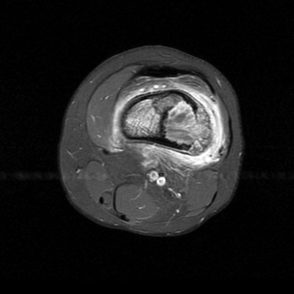 File:Osteosarcoma-distal-femur (6).jpg