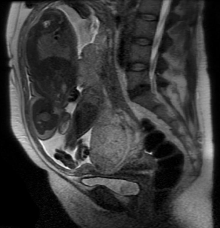 File:Placenta previa MRI 003.jpg