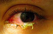 File:Swollen eye with conjunctivitis.jpg