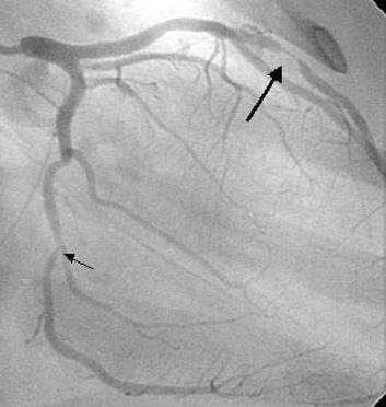 A teenager with MCTD presented as ACS before PCI