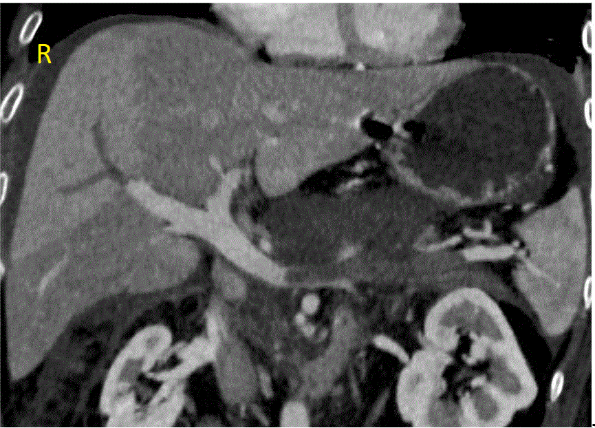 Splenic vein thrombosis CT scan - wikidoc