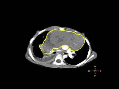 File:Hodgkin's disease ant mediastinum GIF.gif