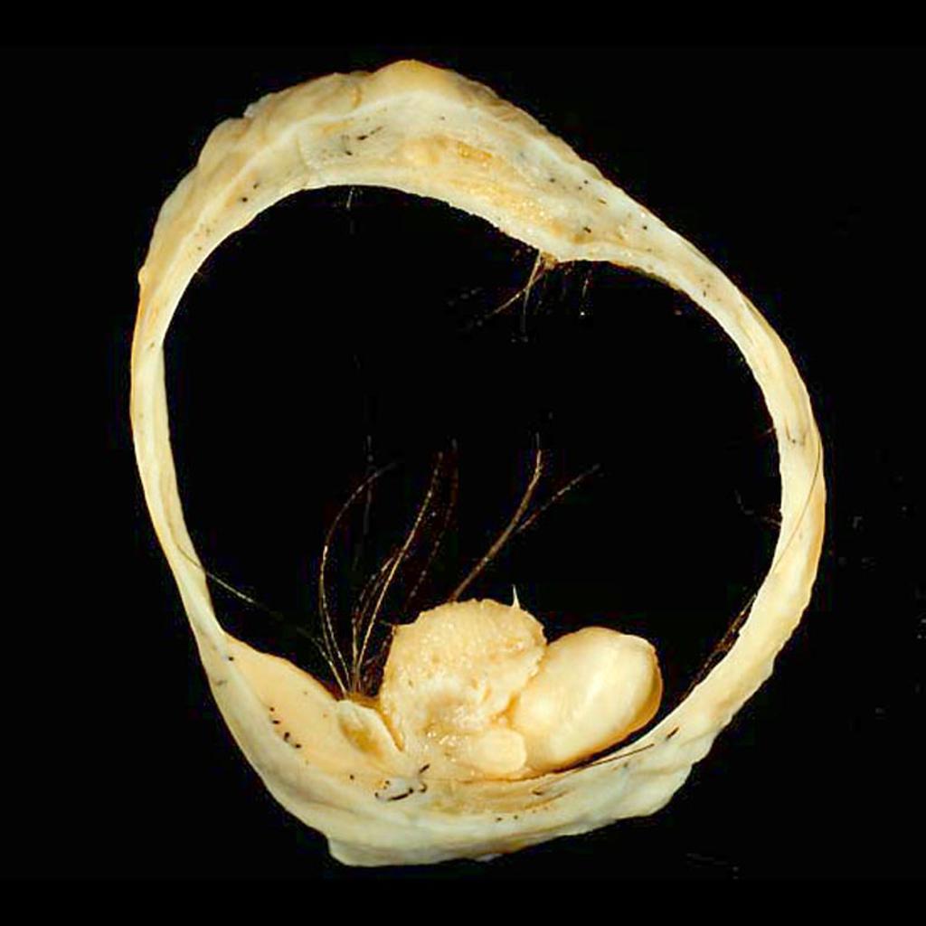 Mature cystic teratoma of the ovary.[6]