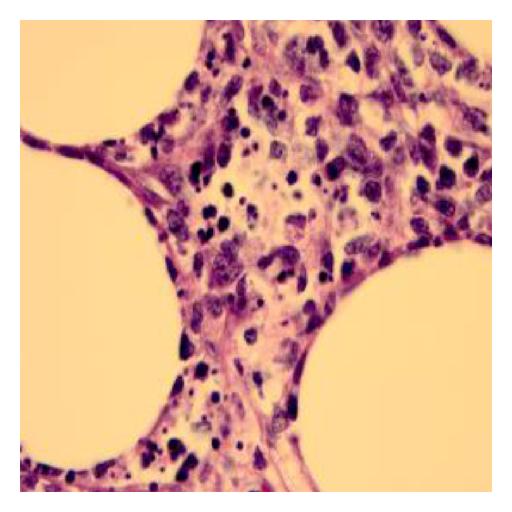 Biopsy of soft tissue : At 100x magnification with oil-immersion biopsy shows area of necrotic debris.[3]