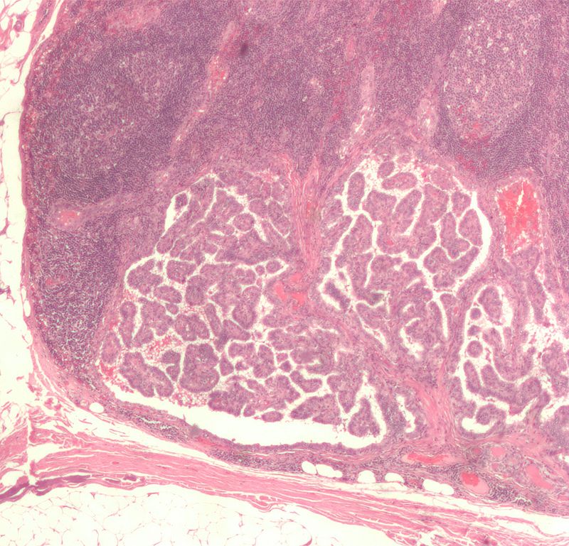 Micrograph of metastatic papillary thyroid carcinoma to a lymph node. H&E stain.[11]