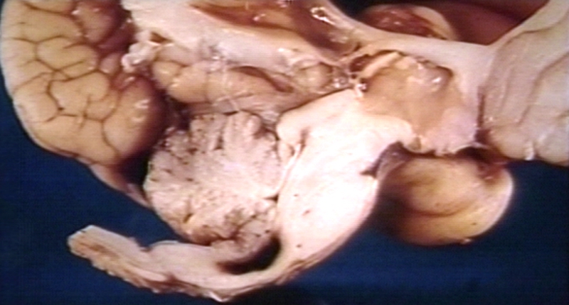 Brain: Arnold Chiari Malformation, Intramedullary Hemorrhage